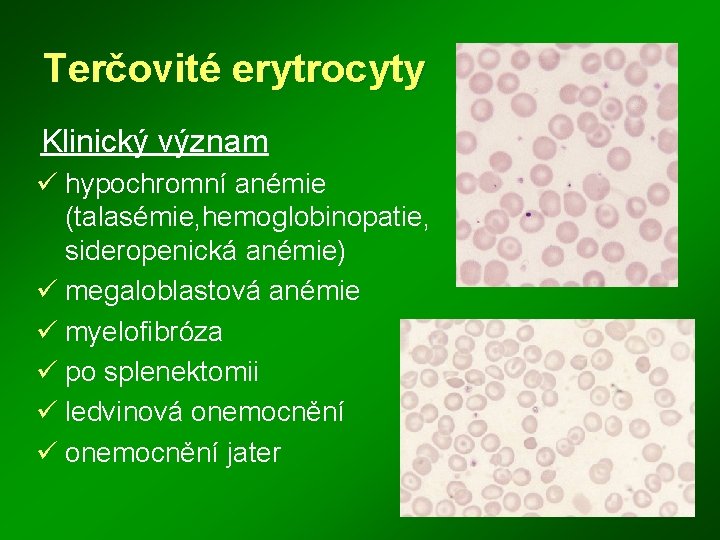 Terčovité erytrocyty Klinický význam ü hypochromní anémie (talasémie, hemoglobinopatie, sideropenická anémie) ü megaloblastová anémie