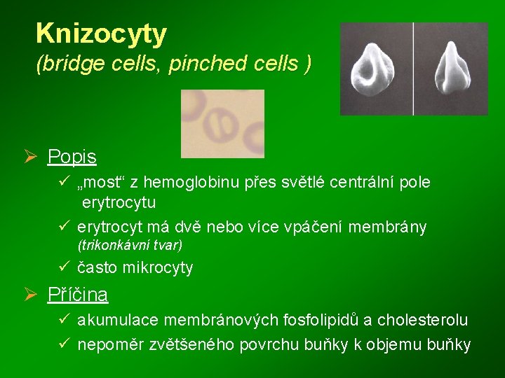 Knizocyty (bridge cells, pinched cells ) Ø Popis ü „most“ z hemoglobinu přes světlé