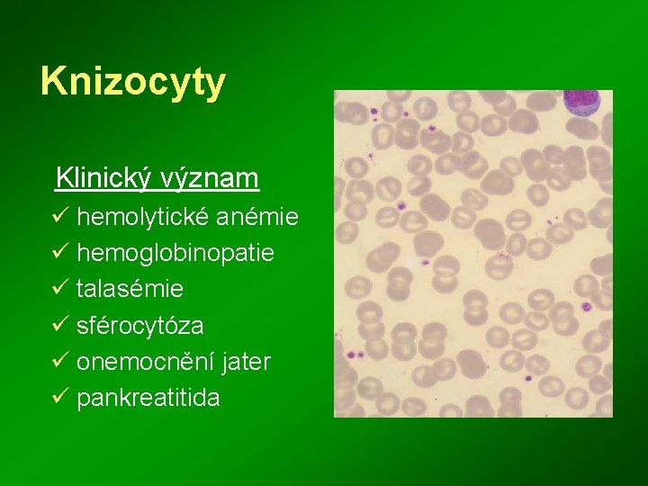 Knizocyty Klinický význam ü hemolytické anémie ü hemoglobinopatie ü talasémie ü sférocytóza ü onemocnění