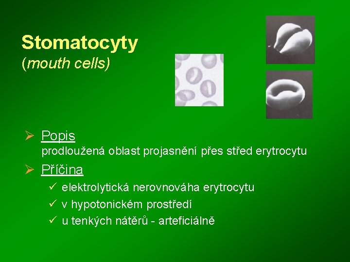 Stomatocyty (mouth cells) Ø Popis prodloužená oblast projasnění přes střed erytrocytu Ø Příčina ü