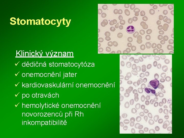 Stomatocyty Klinický význam ü dědičná stomatocytóza ü onemocnění jater ü kardiovaskulární onemocnění ü po