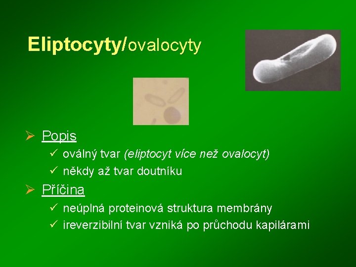 Eliptocyty/ovalocyty Ø Popis ü oválný tvar (eliptocyt více než ovalocyt) ü někdy až tvar