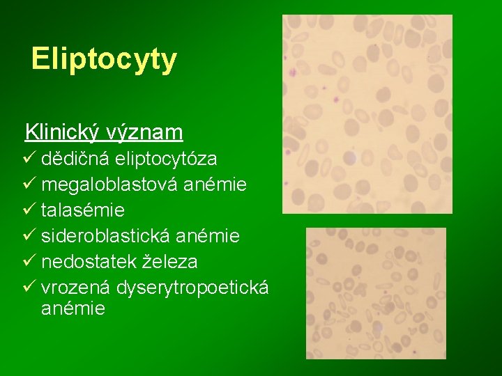 Eliptocyty Klinický význam ü dědičná eliptocytóza ü megaloblastová anémie ü talasémie ü sideroblastická anémie