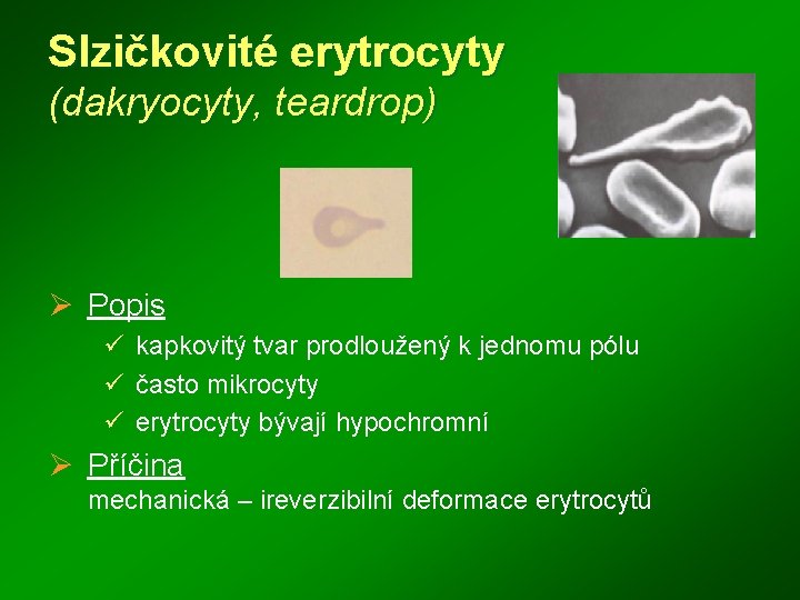 Slzičkovité erytrocyty (dakryocyty, teardrop) Ø Popis ü kapkovitý tvar prodloužený k jednomu pólu ü