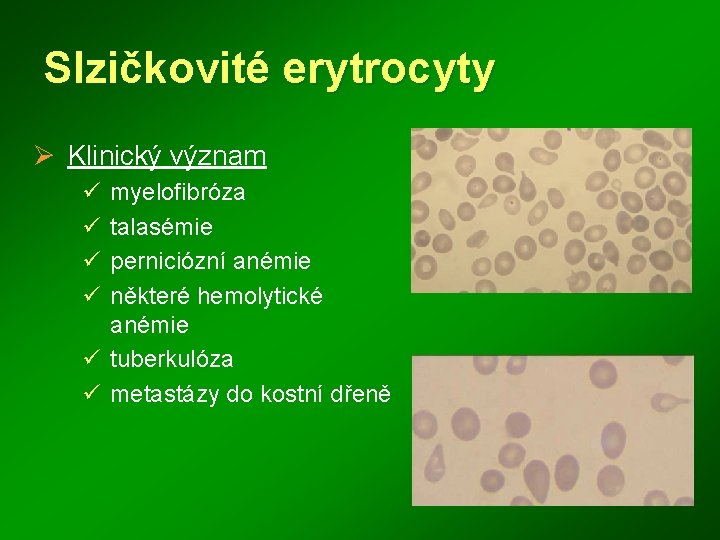 Slzičkovité erytrocyty Ø Klinický význam ü ü myelofibróza talasémie perniciózní anémie některé hemolytické anémie