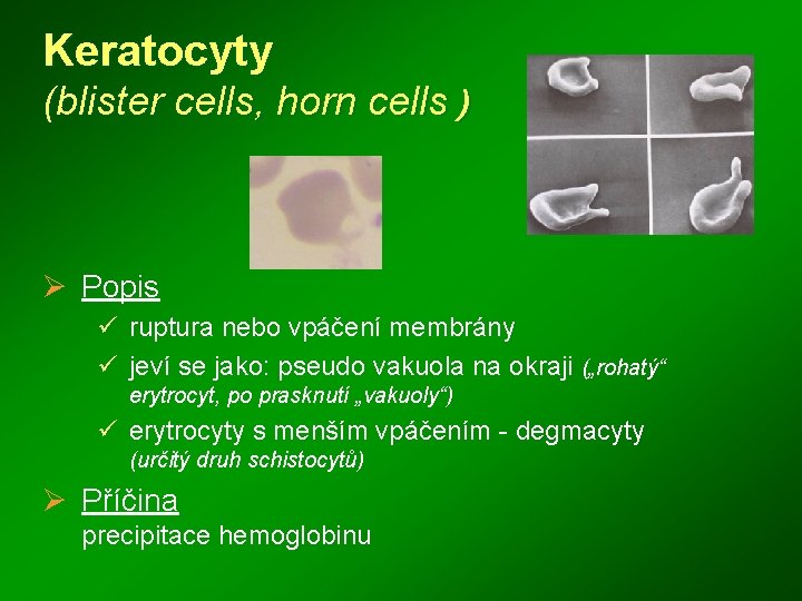 Keratocyty (blister cells, horn cells ) Ø Popis ü ruptura nebo vpáčení membrány ü
