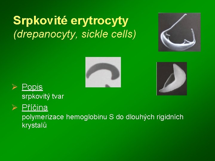 Srpkovité erytrocyty (drepanocyty, sickle cells) Ø Popis srpkovitý tvar Ø Příčina polymerizace hemoglobinu S