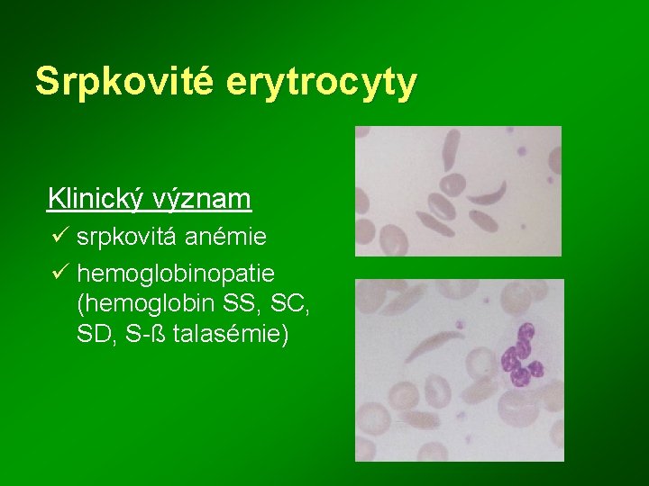 Srpkovité erytrocyty Klinický význam ü srpkovitá anémie ü hemoglobinopatie (hemoglobin SS, SC, SD, S-ß