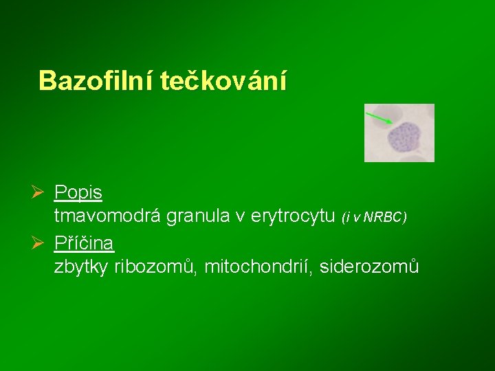 Bazofilní tečkování Ø Popis tmavomodrá granula v erytrocytu (i v NRBC) Ø Příčina zbytky