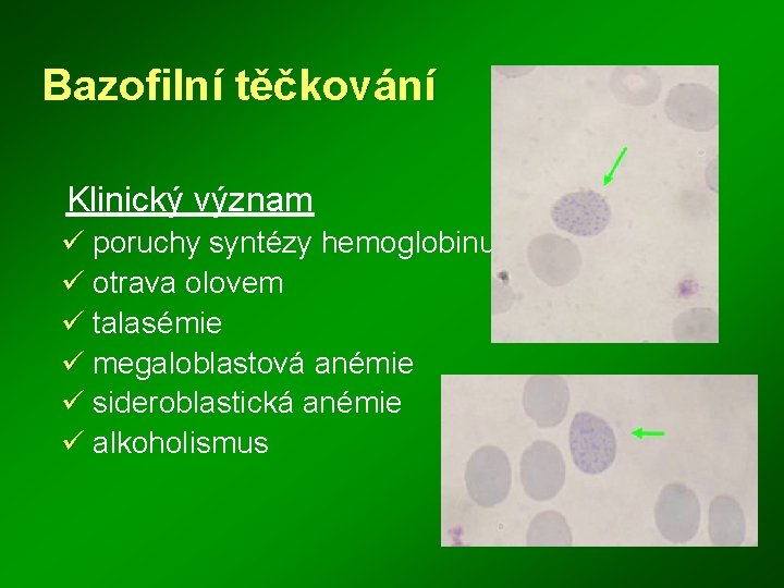 Bazofilní těčkování Klinický význam ü poruchy syntézy hemoglobinu ü otrava olovem ü talasémie ü