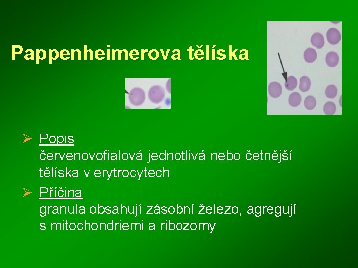 Pappenheimerova tělíska Ø Popis červenovofialová jednotlivá nebo četnější tělíska v erytrocytech Ø Příčina granula