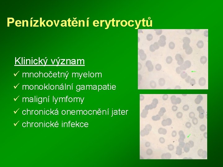 Penízkovatění erytrocytů Klinický význam ü mnohočetný myelom ü monoklonální gamapatie ü maligní lymfomy ü