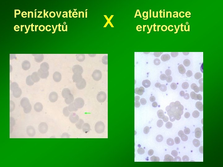 Penízkovatění erytrocytů X Aglutinace erytrocytů 