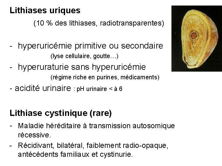 Lithiases uriques (10 % des lithiases, radiotransparentes) - hyperuricémie primitive ou secondaire (lyse cellulaire,