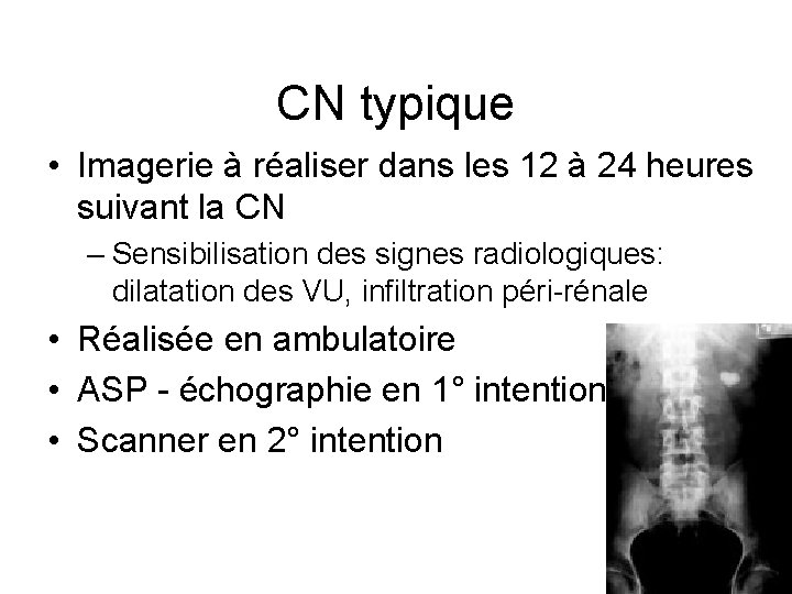 CN typique • Imagerie à réaliser dans les 12 à 24 heures suivant la CN typique • Imagerie à réaliser dans les 12 à 24 heures suivant la