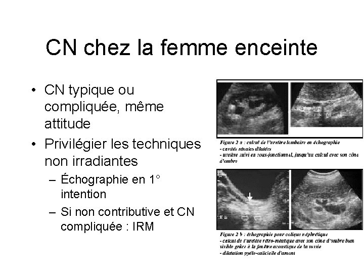 CN chez la femme enceinte • CN typique ou compliquée, même attitude • Privilégier CN chez la femme enceinte • CN typique ou compliquée, même attitude • Privilégier