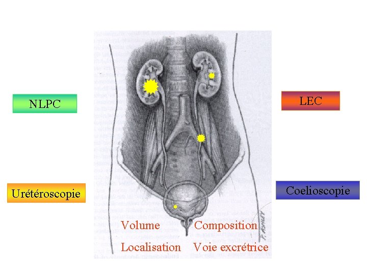 NLPC LEC Coelioscopie Urétéroscopie Volume Composition Localisation Voie excrétrice NLPC LEC Coelioscopie Urétéroscopie Volume Composition Localisation Voie excrétrice