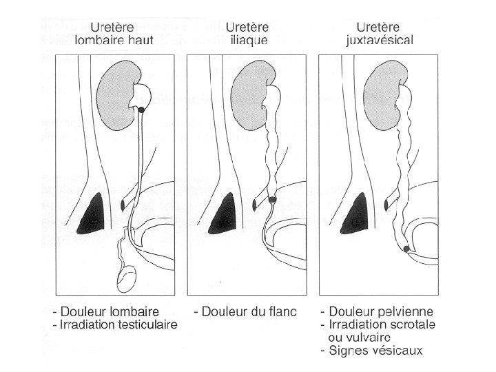 Colique néphrétique: • • Douleur intense évoluant par vague Nausées, vomissements Hématurie macro ou