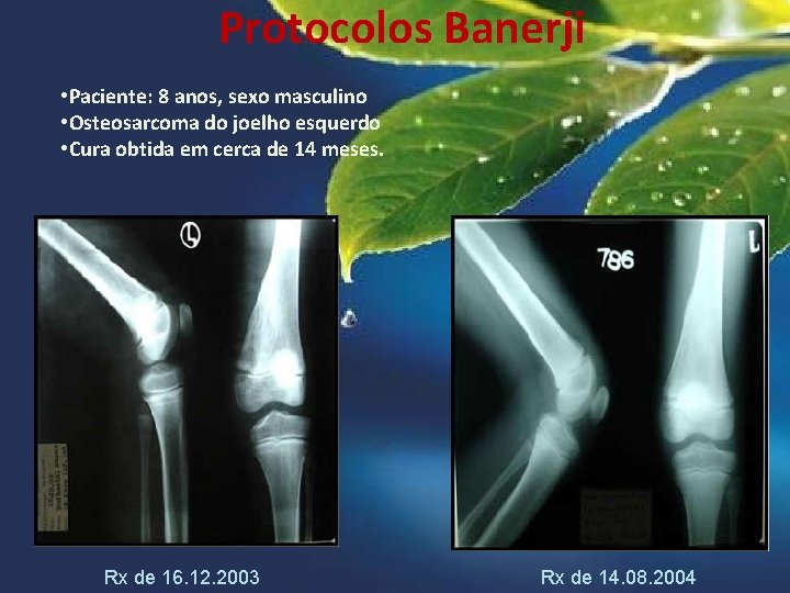 Protocolos Banerji • Paciente: 8 anos, sexo masculino • Osteosarcoma do joelho esquerdo •