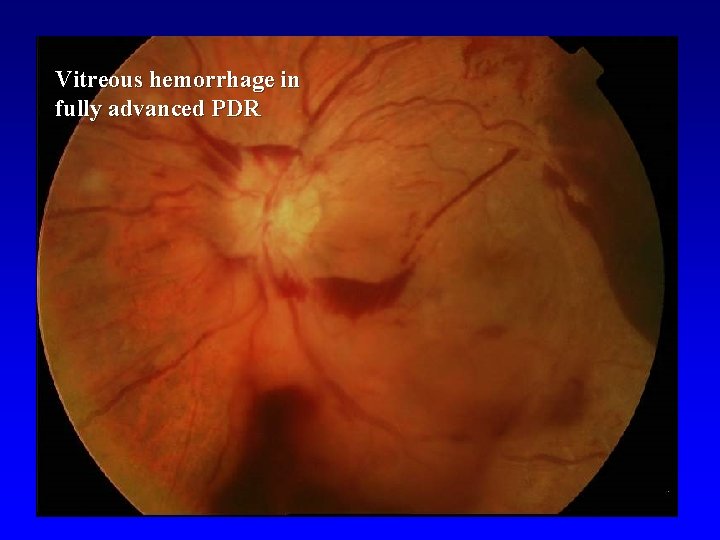 Vitreous hemorrhage in fully advanced PDR 