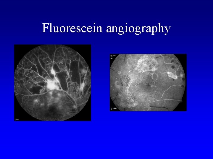 Fluorescein angiography 