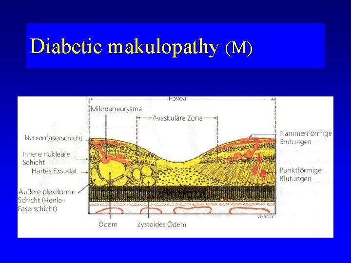 Diabetic makulopathy (M) 