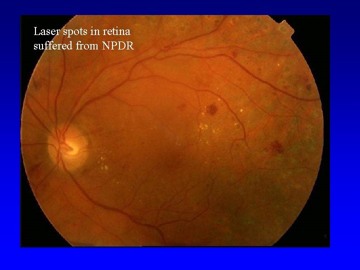 Laser spots in retina suffered from NPDR 