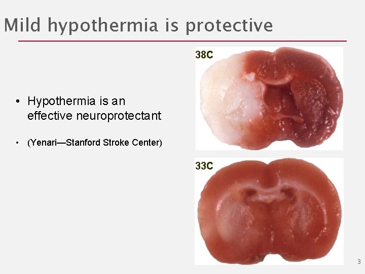 Phase 23 study of intravenous thrombolysis and hypothermia