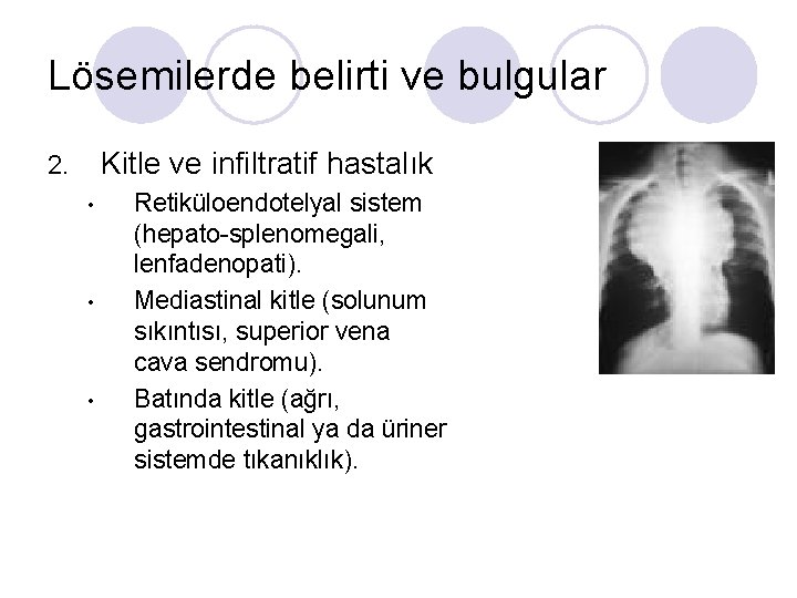 Lösemilerde belirti ve bulgular Kitle ve infiltratif hastalık 2. • • • Retiküloendotelyal sistem