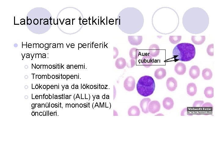 Laboratuvar tetkikleri l Hemogram ve periferik yayma: ¡ ¡ Normositik anemi. Trombositopeni. Lökopeni ya