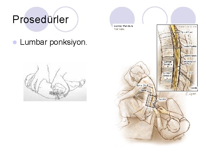 Prosedürler l Lumbar ponksiyon. 