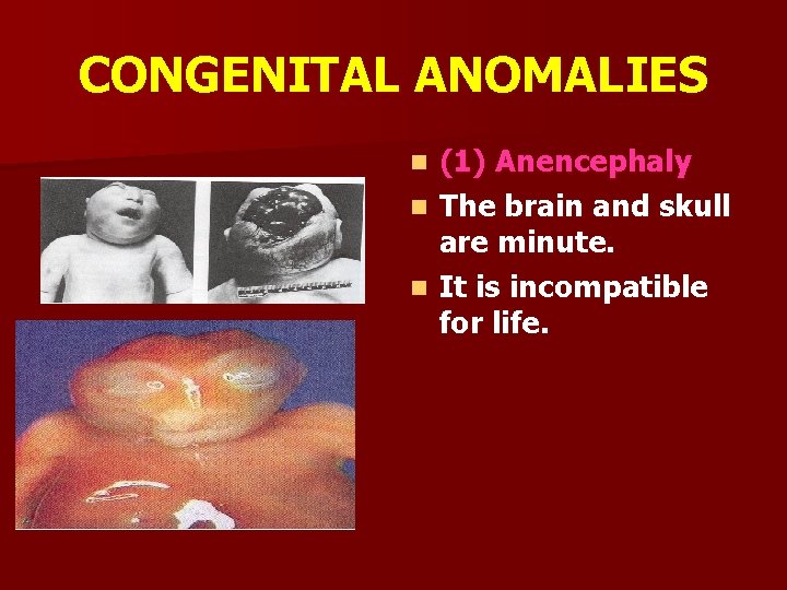 CONGENITAL ANOMALIES (1) Anencephaly n The brain and skull are minute. n It is