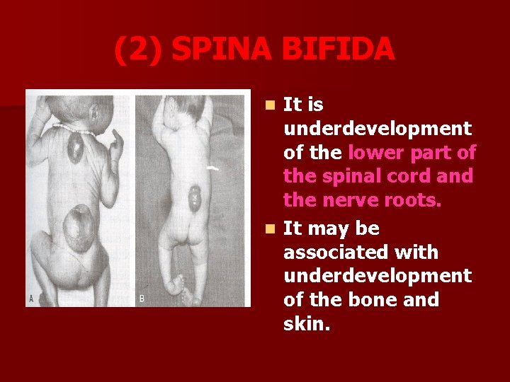(2) SPINA BIFIDA It is underdevelopment of the lower part of the spinal cord