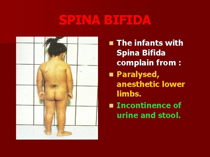 SPINA BIFIDA The infants with Spina Bifida complain from : n Paralysed, anesthetic lower