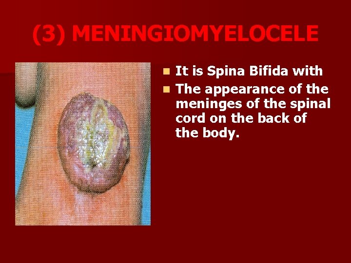 (3) MENINGIOMYELOCELE It is Spina Bifida with n The appearance of the meninges of