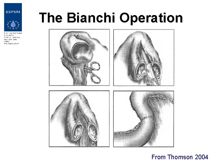 The Bianchi Operation From Thomson 2004 