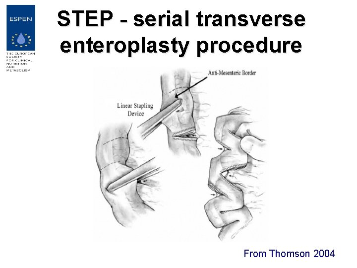 STEP - serial transverse enteroplasty procedure From Thomson 2004 