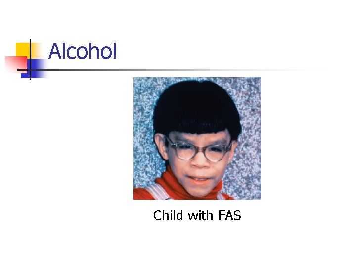 Alcohol Child with FAS 