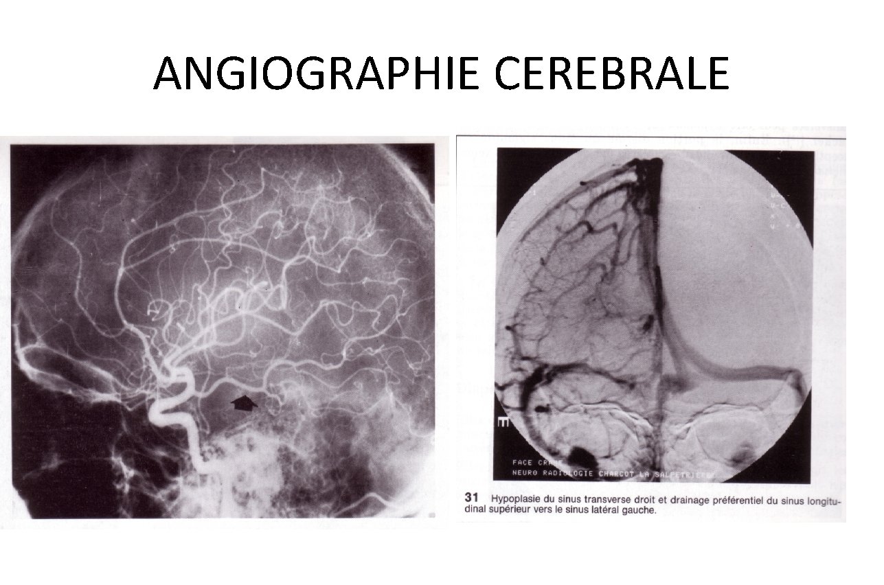 ANGIOGRAPHIE CEREBRALE 