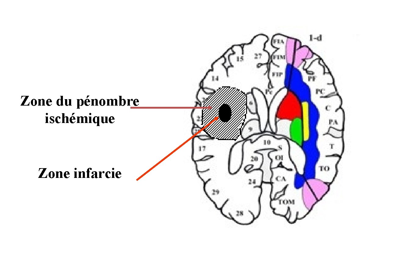 Zone du pénombre ischémique Zone infarcie 