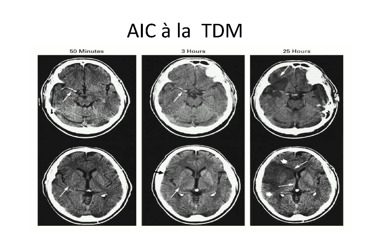 AIC à la TDM 