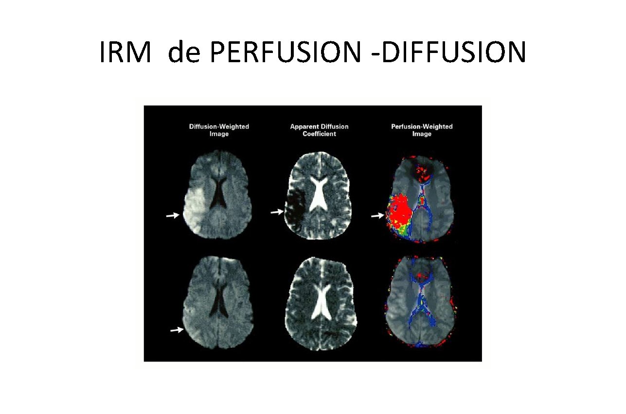 IRM de PERFUSION -DIFFUSION 