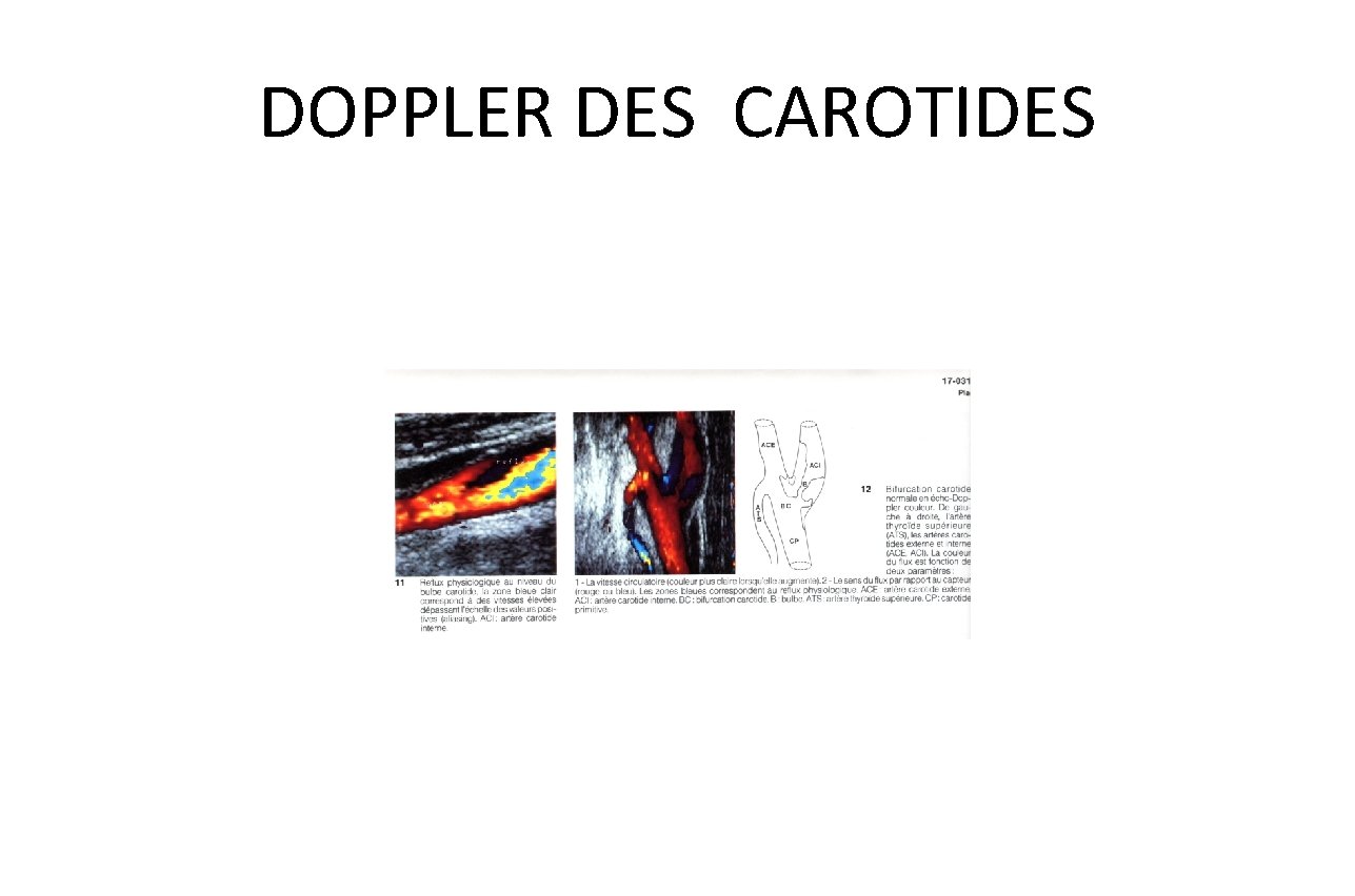 DOPPLER DES CAROTIDES 