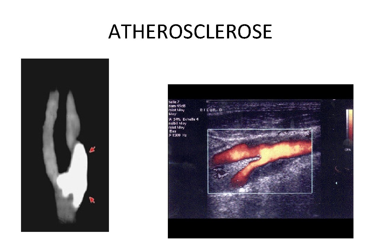 ATHEROSCLEROSE 