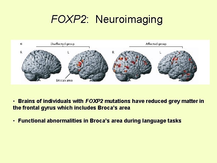 FOXP 2: Neuroimaging • Brains of individuals with FOXP 2 mutations have reduced grey
