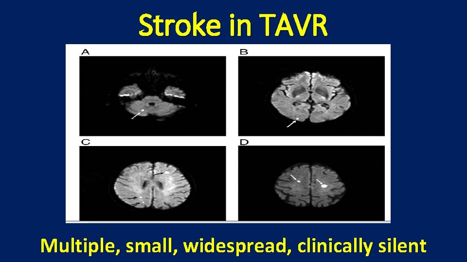 Stroke in TAVR Multiple, small, widespread, clinically silent 
