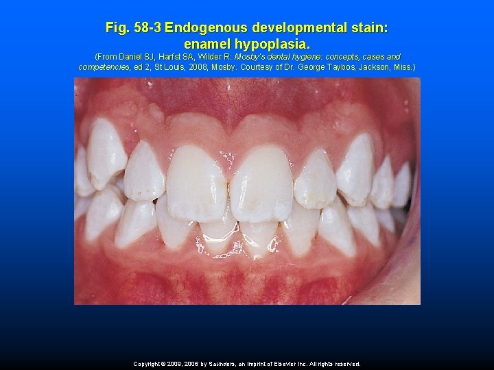 Fig. 58 -3 Endogenous developmental stain: enamel hypoplasia. (From Daniel SJ, Harfst SA, Wilder