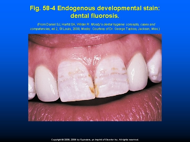 Fig. 58 -4 Endogenous developmental stain: dental fluorosis. (From Daniel SJ, Harfst SA, Wilder