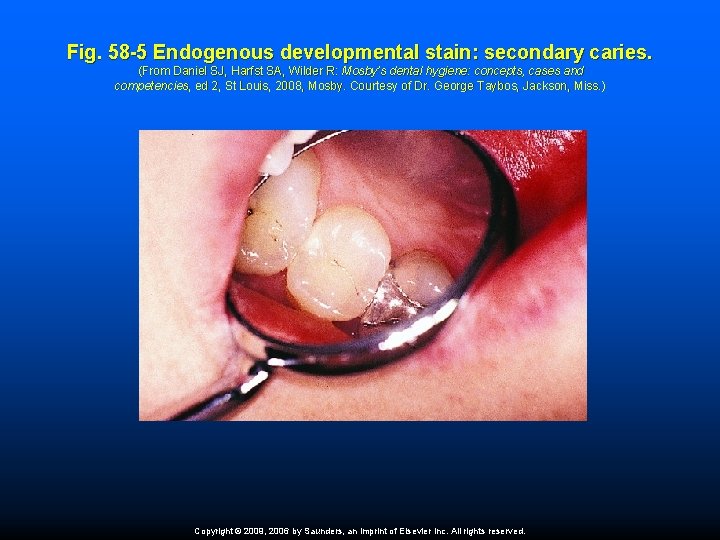 Fig. 58 -5 Endogenous developmental stain: secondary caries. (From Daniel SJ, Harfst SA, Wilder