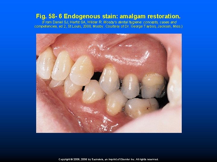 Fig. 58 - 6 Endogenous stain: amalgam restoration. (From Daniel SJ, Harfst SA, Wilder